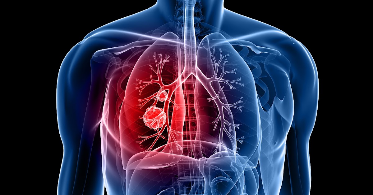 Llega a Perú nueva terapia personalizada para pacientes con cáncer de pulmón Salud en Casa Perú Llega a Perú nueva terapia personalizada para pacientes con cáncer de pulmón Salud en Casa Perú