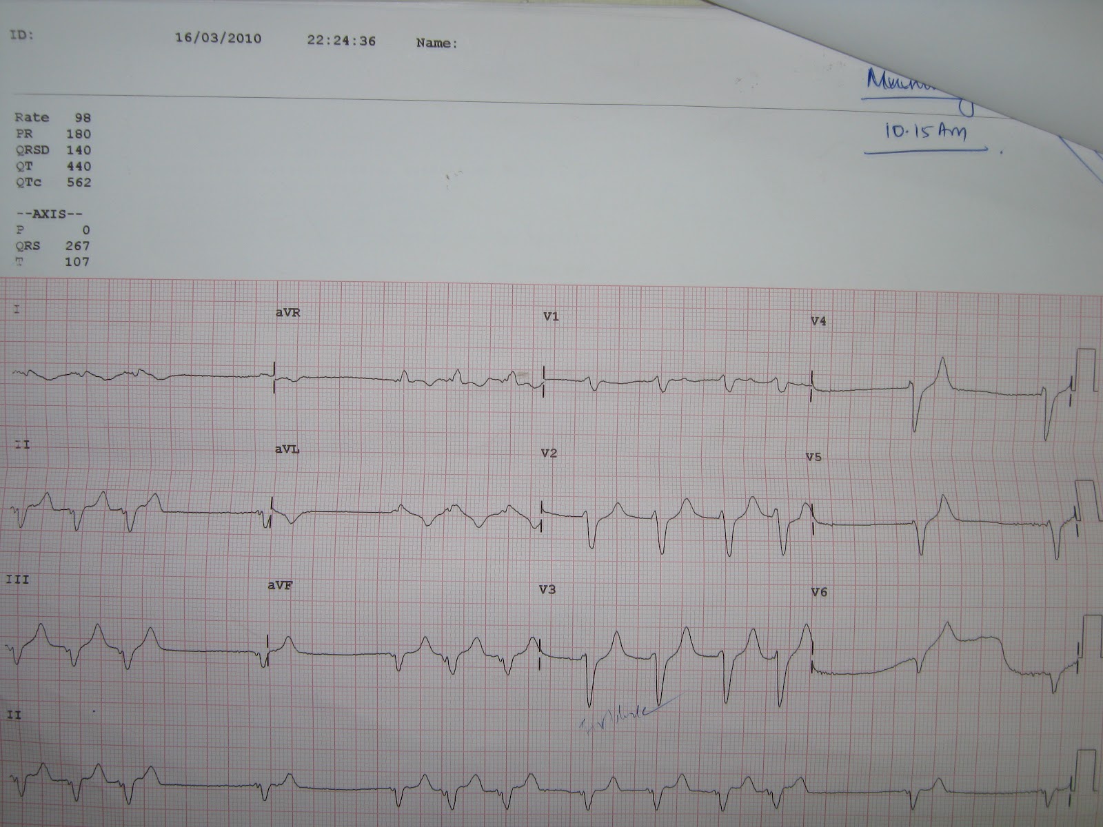 Medical Images Gallery Hyperkalemia in Chronic Kidney Disease case ECG CHanges