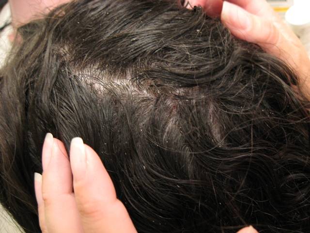 head lice in adults