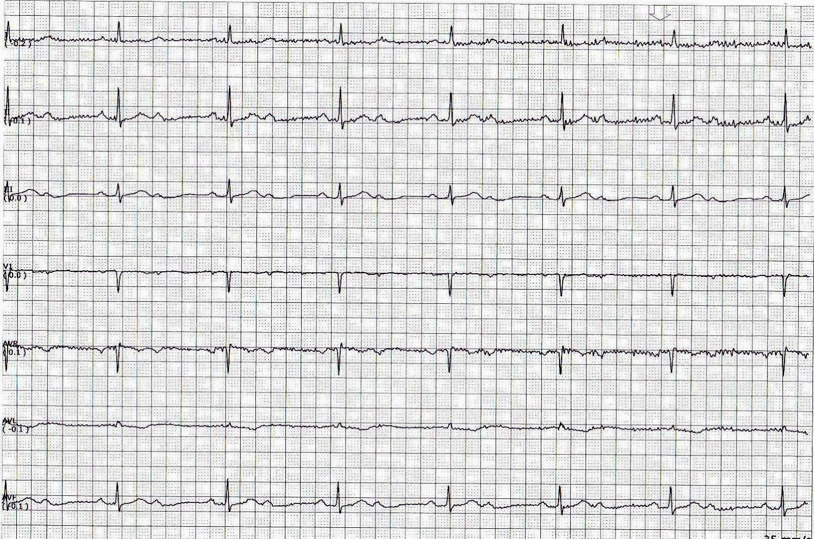 Second Degree AV Block Type I And 2:1 AV Block ECG Learn, 60% OFF
