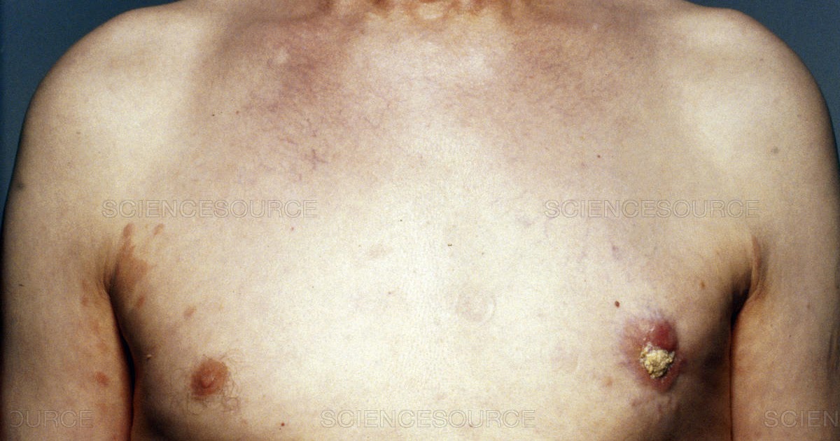 Da dove iniziare con steroidi macchie?