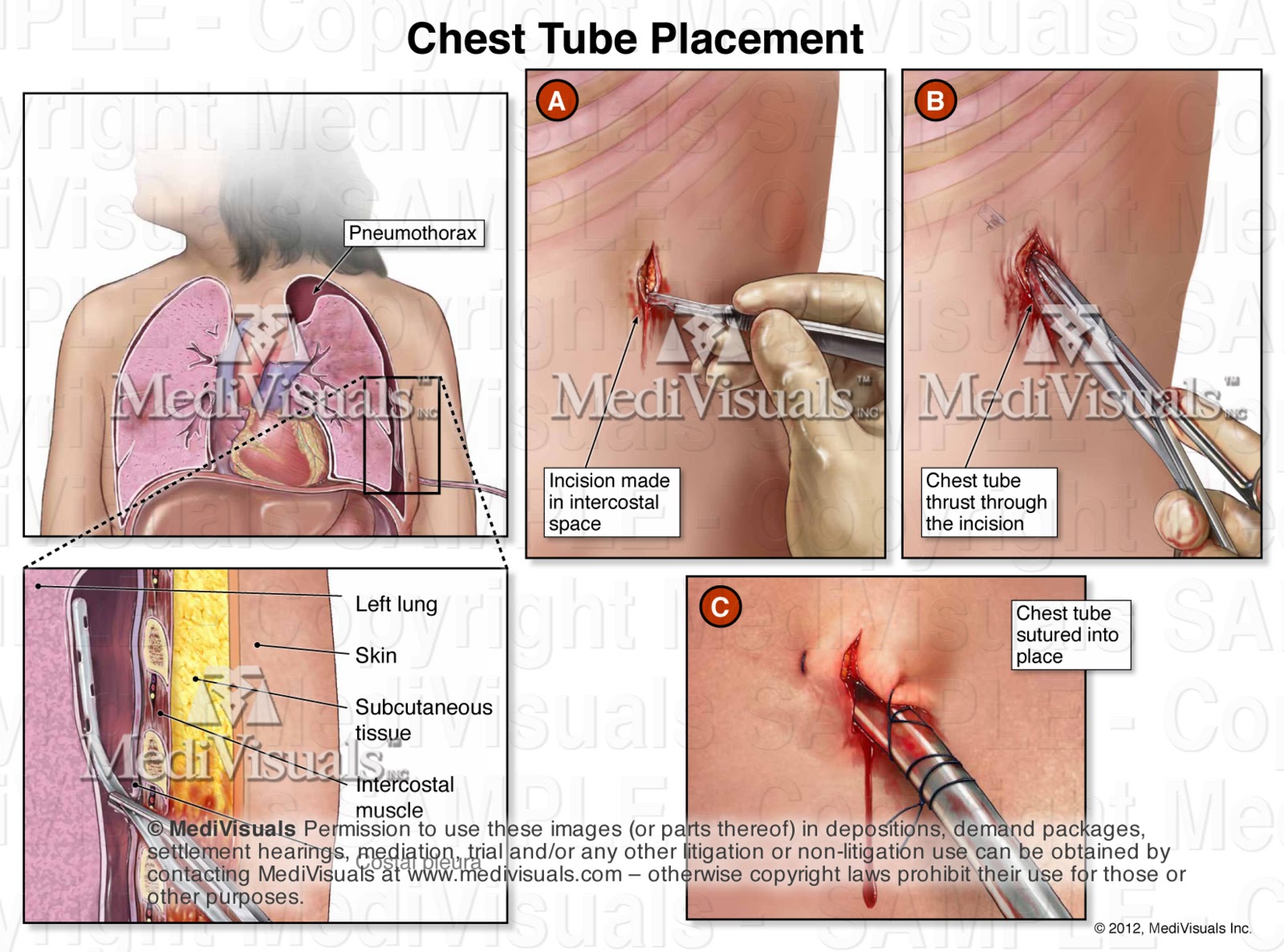 The Medical Legal Exhibit Expert Blog Pneumothorax, Hemothorax
