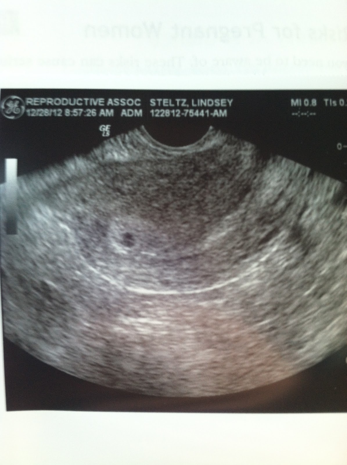 Our Journey IVF First Ultrasound!!!