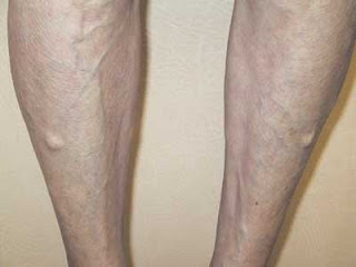 muscle hernia