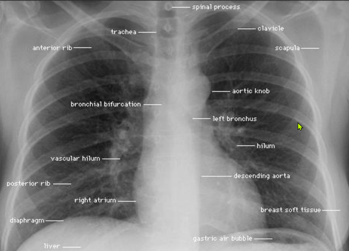 MEDLAND MARKINGS CHEST X RAY medland-markings-chest-x-ray