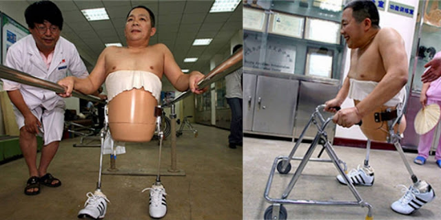 Kisah Perjuangan Hidup Pria Bertubuh Separuh Kisah Perjuangan Hidup Pria Bertubuh Separuh