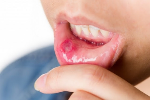 Canker sores in the mouth: a vegetable eliminates them