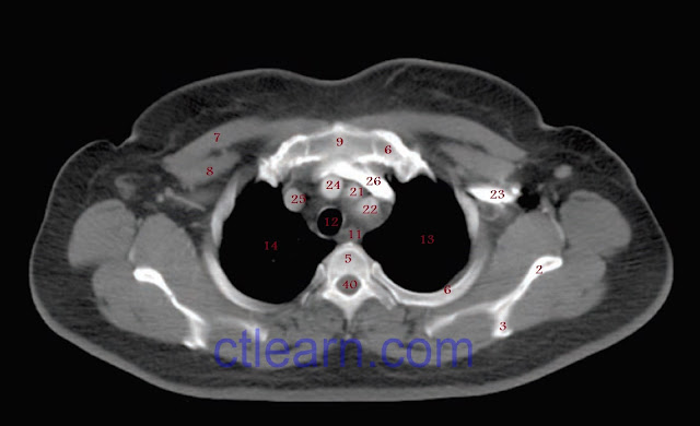 Anatomy CT Axial thorax 