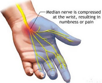 Kesemutan atau Paresthesia