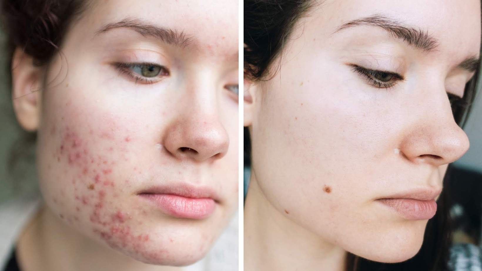Julia Caban Blog Acne Skincare Overnight Tips Tricks How To