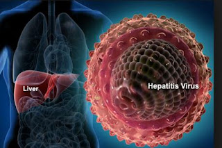 हेपेटाइटिस, हेपेटाइटिस क्या है, हेपेटाइटिस b, हेपेटाइटिस ई, हेपेटाइटिस c, हेपेटाइटिस सी, हेपेटाइटिस सी के लक्षण, अल्कोहलिक हेपेटाइटिस, हेपेटाइटिस सी का आयुर्वेदिक उपचार