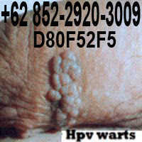 genital warts kutil kelamin kondiloma akuminata 