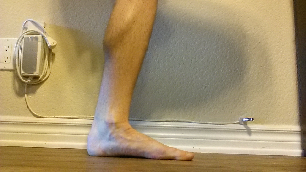 Midfoot Arch Support and the Posterior Tibialis DOCTORS OF RUNNING