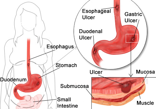 Digestive Ulcers