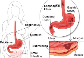 Digestive Ulcers