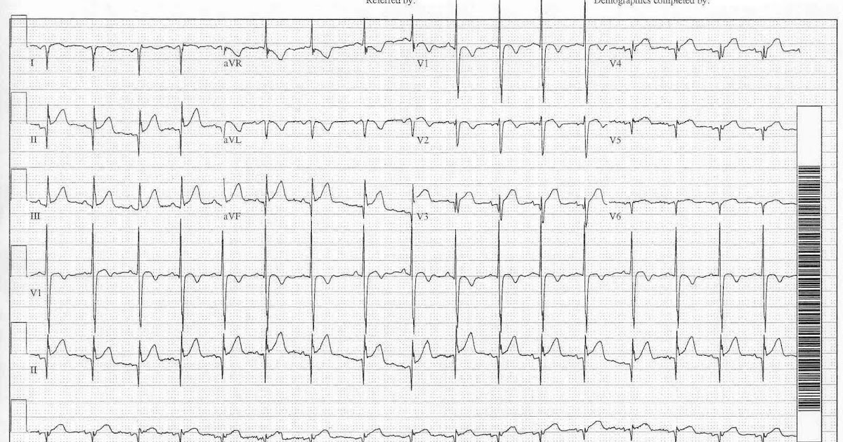 электроды экг при декстрокардии. декстрокардия наложение электродов экг. постановка электродов экг при декстрокардии. декстрокардия на экг. наложение электродов при декстрокардии.