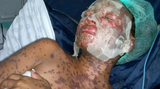 Ngeri ! Akibat Alergi Obat, Seorang Ibu Wajahnya Membusuk Ngeri ! Akibat Alergi Obat, Seorang Ibu Wajahnya Membusuk