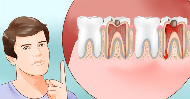 8 NATURAL TOOTHACHE REMEDIES THAT ARE HIDING IN YOUR KITCHEN