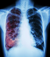 tuberculosis pulmonar: marzo 2017
