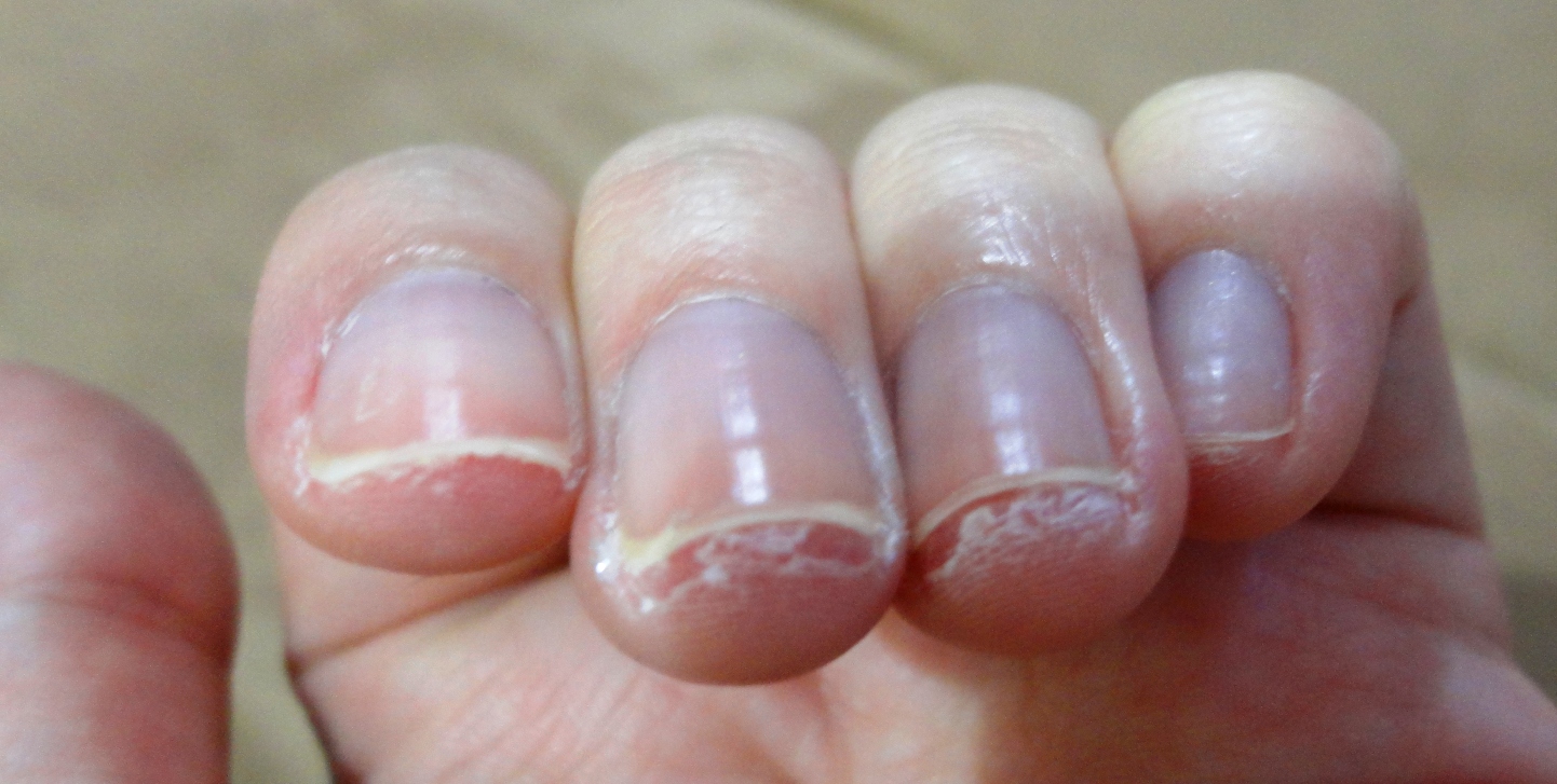 How To Get Rid Of Dry Skin Around Your Fingernails at Michael