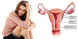 Obat Polip Rahim Herbal Obat Polip Rahim Herbal