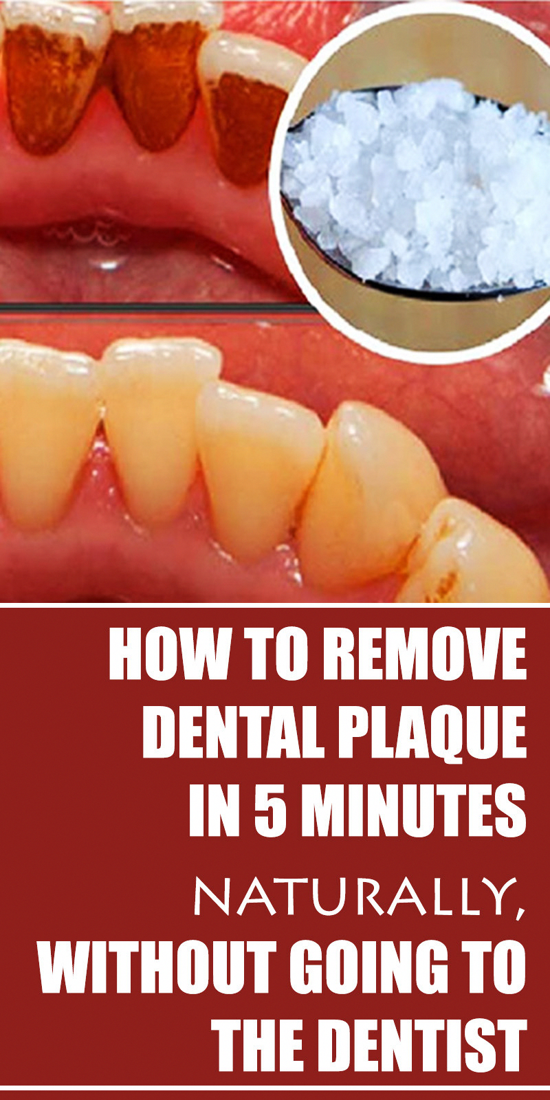 how-to-remove-dental-plaque-in-5-minutes-naturally-without-going-to