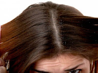 5 Cara Menghilangkan Kutu Rambut dan Cara Mencegahnya