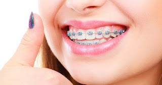 Best Orthodontist Melbourne