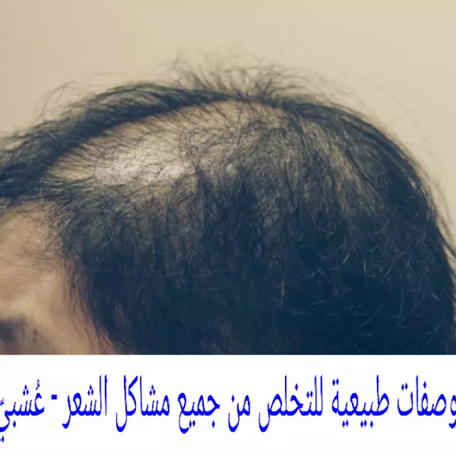 وصفات طبيعية للتخلص من جميع مشاكل الشعر Avoid the heir problem - عُشبيّ