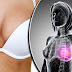 Καρκίνος του μαστού – Συμπτώματα: Τα 9 προειδοποιητικά σημάδια