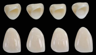 Một số ưu điểm của răng sứ không kim loại