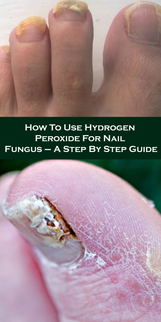 How To Use Hydrogen Peroxide For Nail Fungus A Step By Step Guide