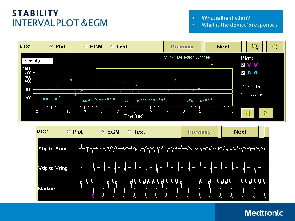 CVT Mohd Farid: Concept Of ICD Technology-SVT Discrimination Algorithms ...
