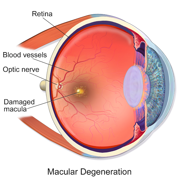 What causes AMD macular degeneration