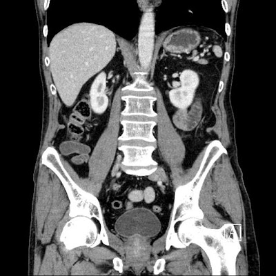 Appendicularis mucocele 3