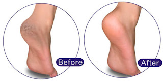 How To Fix Cracked Heels Permanently Diy Cracked Heels