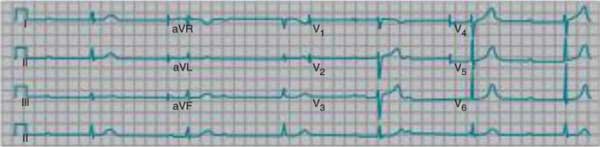 EKG