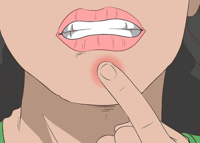 البثور على الذقن تحت الجلد وصفاتي