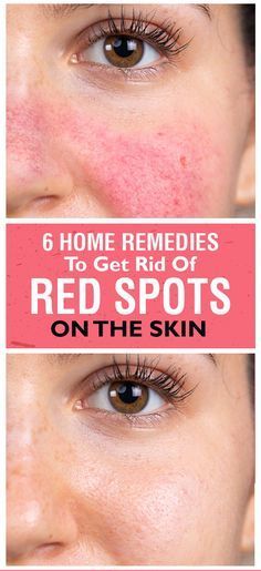 How To Get Rid Of Red Spots On Face 6 Home Remedies And Tips Health News