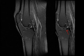 How to read an MRI right knee profile resonata magnetica ACL tear break ligament