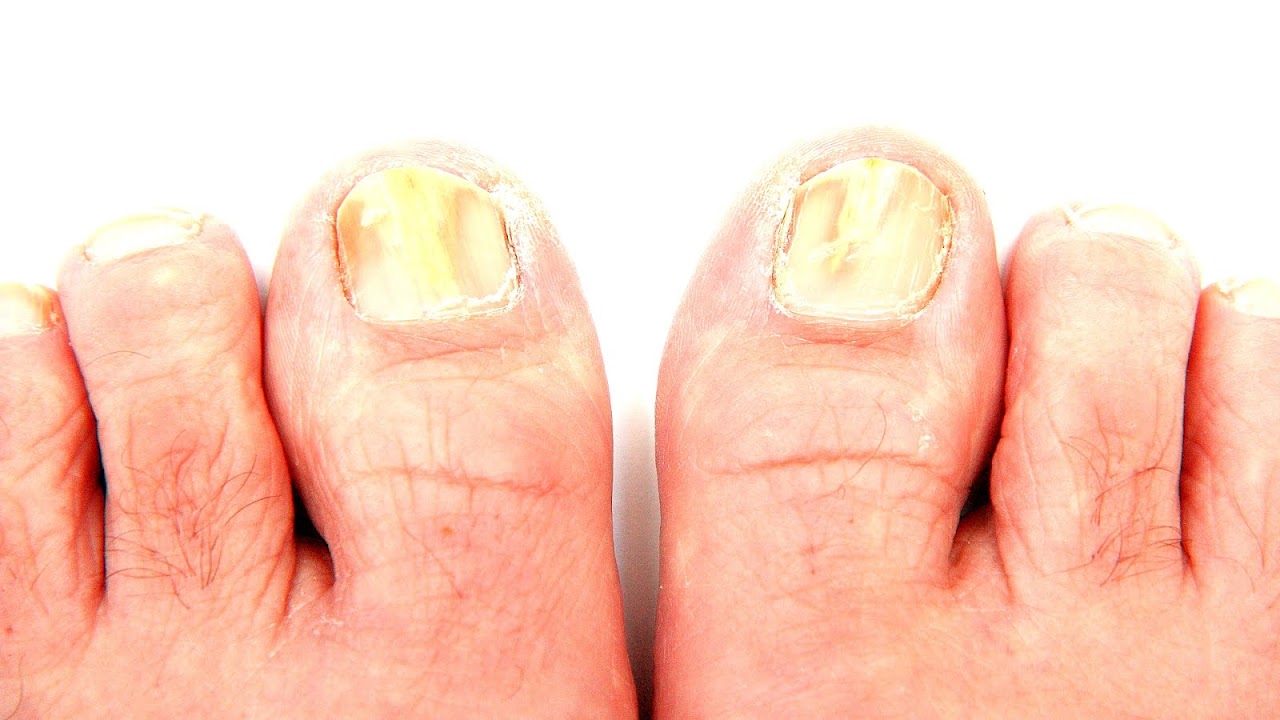 How To Get Rid Of Yellow Toenail Fungus Yellow Choices