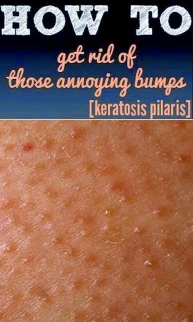 How To Get Rid Of Arm Bumps Aka Keratosis Pilaris Or Chicken Skin