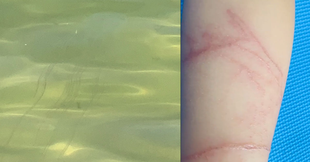 Sciency Thoughts Girl stung by Box Jellyfish off the coast of Sentosa
