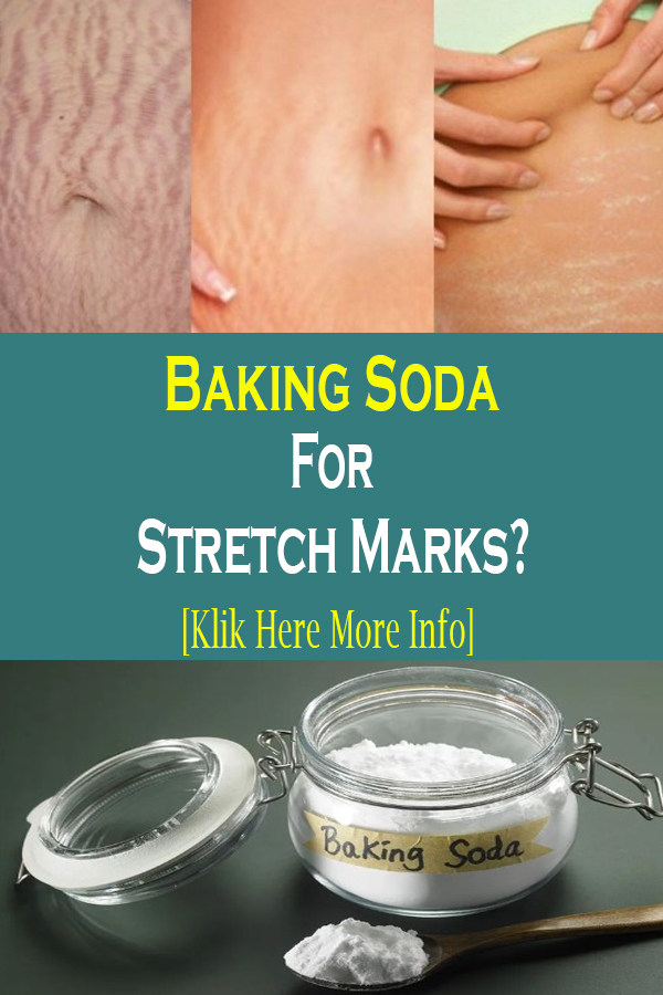 How To Use Baking Soda For Stretch Marks exstremboard