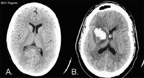 CT imaging of the brain