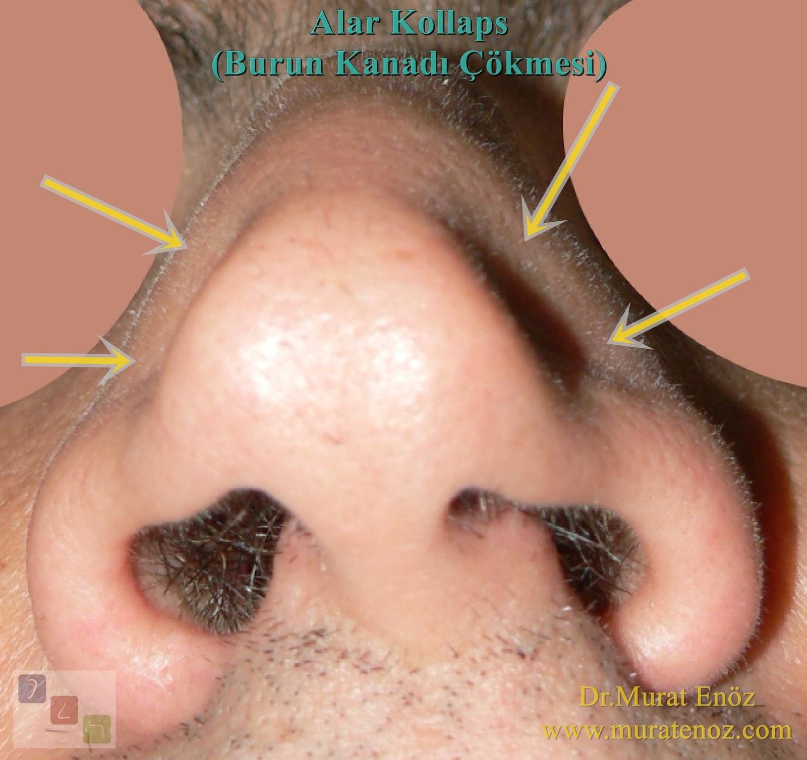 "Burun Kanadı Çökmesi ve Tedavisi" Videosu Yayınladık! KBB Uzmanı