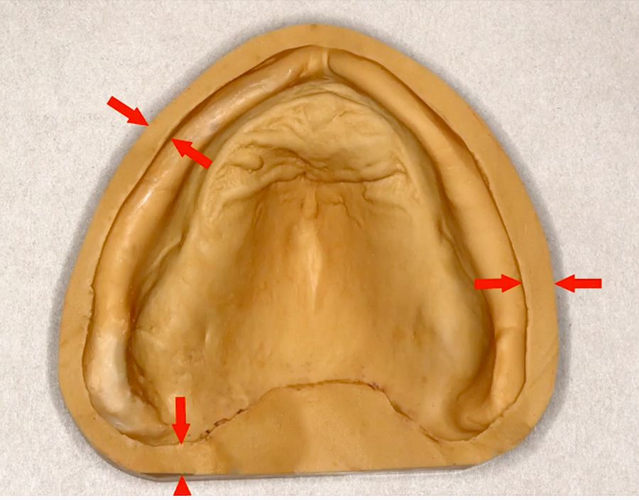 PROSTHODONTICS Trimming Master Casts for Complete Dentures