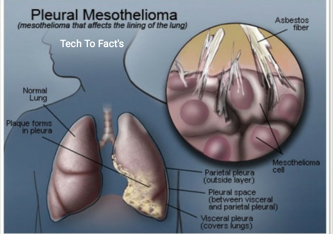 what-is-pleural-mesothelioma
