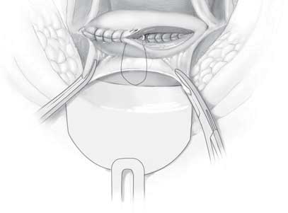 Bladder is repaired with second layer