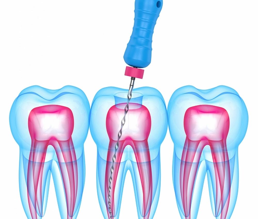 Why Root Canals Fail OdontoVida